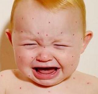 什么是湿疹用什么药膏,什么是湿疹的根本原因