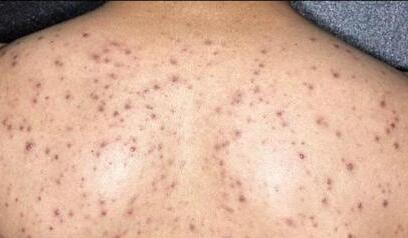 背部长痘怎么办严打背部暗疮有五招!