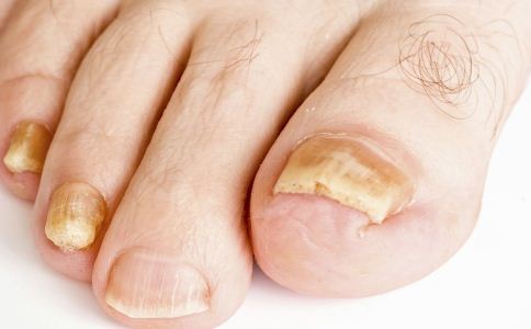 指甲裂开是怎么回事,指甲裂开是什么原因造成的
