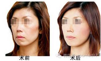 脸上部分凹陷,年龄增长脸颊凹陷