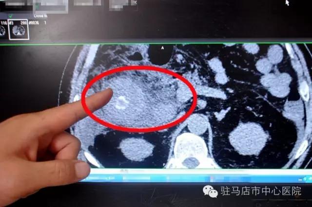 他吃了一顿虾，胆囊竟肿成“火龙果”！只因为这种常见病