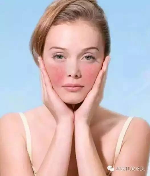 皮肤老是反复过敏是肝脏不好吗,激素依赖皮炎过敏怎样修复