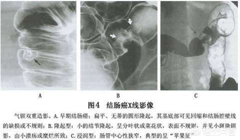 怎么判断肠结节,肺部结节7mm怎么判断良性还是恶性