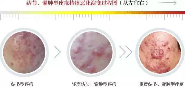 白头粉刺和炎症丘疹的区别,粉刺结节的最佳治疗方法