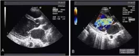 主动脉夹层动脉瘤如何检查和防治,主动脉夹层动脉瘤的超声表现