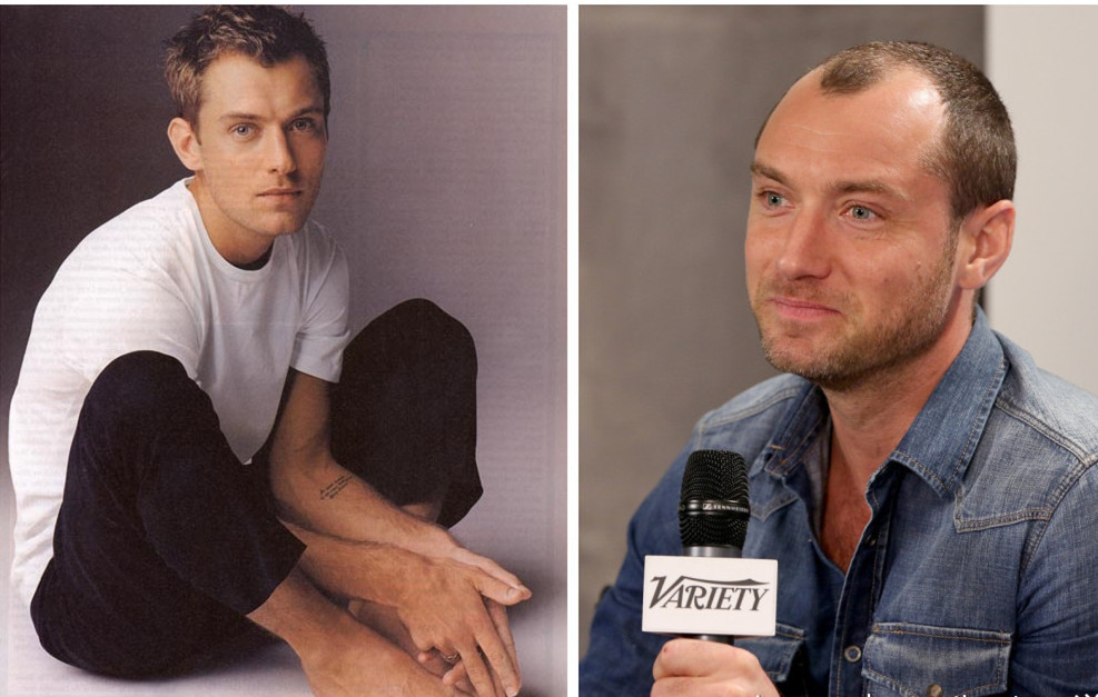 m型脱发额头高怎么才能恢复,单m型脱发怎么才能恢复