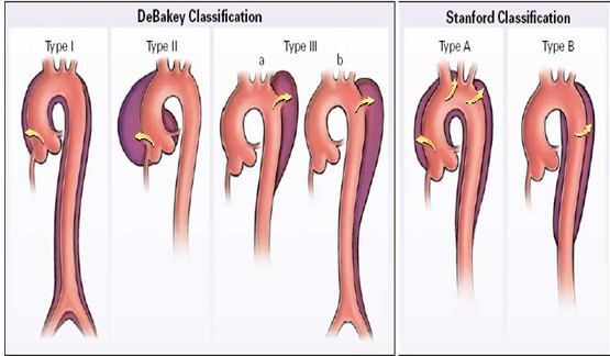 美国治疗主动脉夹层,倪海厦治疗主动脉夹层