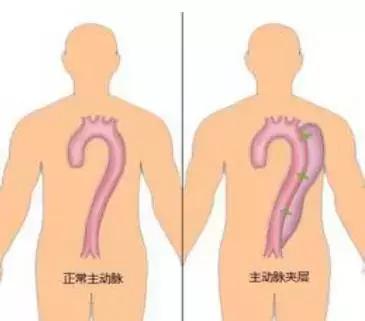 主动脉夹层动脉瘤如何检查和防治,主动脉夹层动脉瘤的超声表现