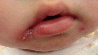 嘴唇上火留的黑印子怎么办,上火嘴唇长泡会留印吗