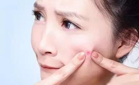 战痘血泪史我的祛痘经验,美妆博主祛痘经历