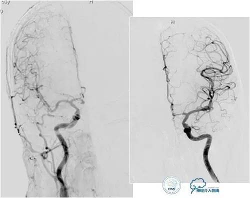 球囊辅助Onyx栓塞治疗硬脑膜动静脉瘘（DAVF）