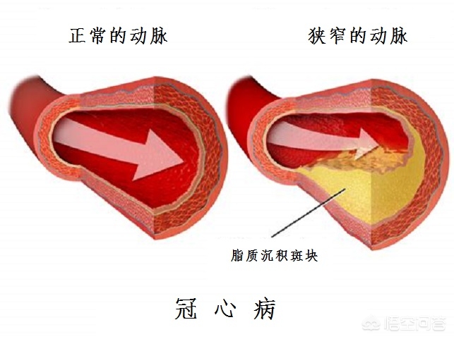 吃中药能治疗冠心病和心绞痛吗,吃中药治冠心病能吃辛辣的吗