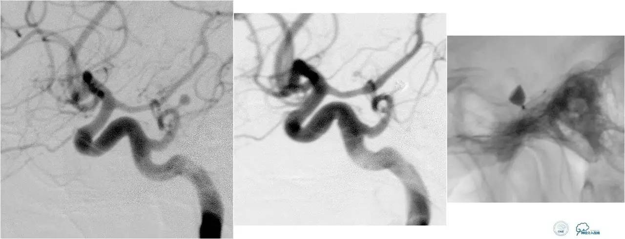 球囊辅助Onyx栓塞治疗硬脑膜动静脉瘘（DAVF）