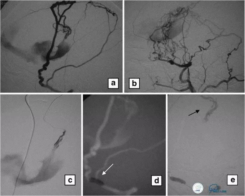 球囊辅助Onyx栓塞治疗硬脑膜动静脉瘘（DAVF）
