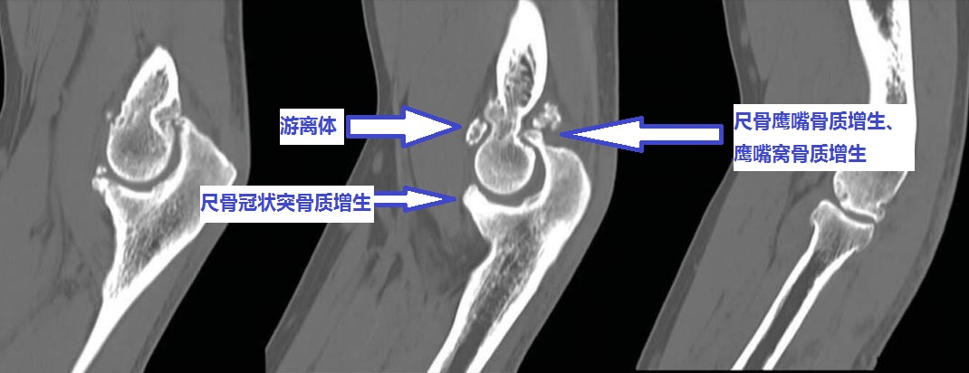 20年前肘关节伸不直,肘关节手术失败十几年伸不直