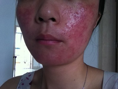 激素性皮炎修复期为什么脸总痒,激素性皮炎反复起红疹怎么办