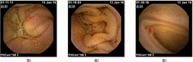 消化道胶囊内镜,胶囊内镜可以看到全部消化道吗