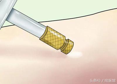 十几年刀疤疤痕修复的最新方法,疤痕修复的最新方法淡疤效果