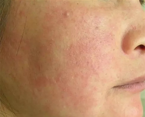 面部皮肤有血丝是什么原因,面部发红还有血丝是怎么回事