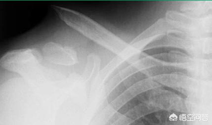 宝宝骨折保守治疗跟手术治疗,为什么儿童骨折医生建议保守治疗