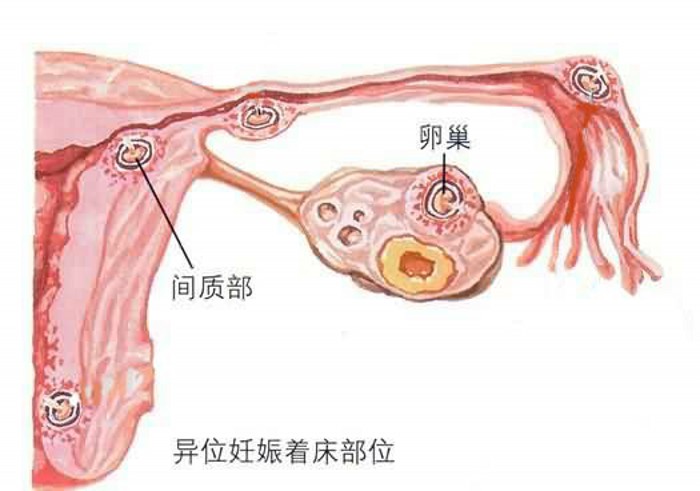 未破裂型输卵管妊娠的超声表现,宫角妊娠与输卵管间质部妊娠区别