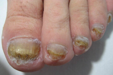 灰指甲治疗颜色正常了但还是很厚,灰指甲是指甲颜色变黑吗
