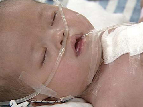 先天愚型宝宝可以治疗吗,先天愚型的新生儿有哪些表现