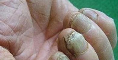 各种灰指甲问题看过来,灰指甲的真菌进入血液有危害吗