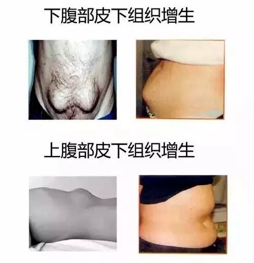 胰岛素针头大小号,小针头大针头