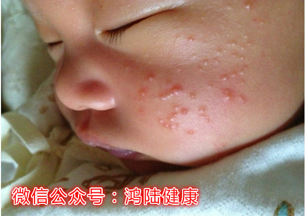 怎么确认宝宝是鹅口疮还是湿疹,婴幼儿鹅口疮症状