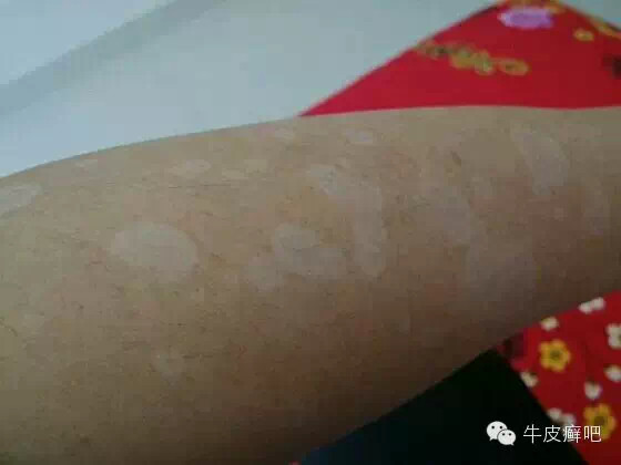 医院专家教你治疗牛皮癣,专家专治牛皮癣方法