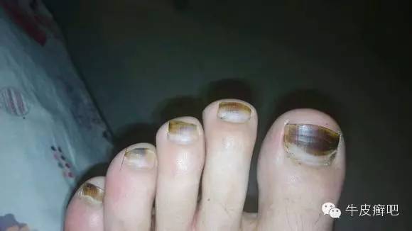 医院专家教你治疗牛皮癣,专家专治牛皮癣方法