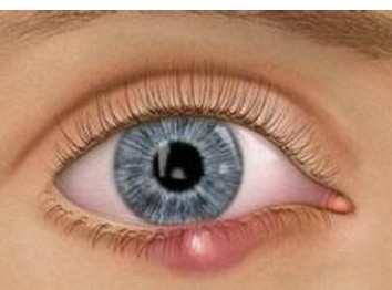 什么是宝宝针眼？该如何治疗宝宝针眼呢？