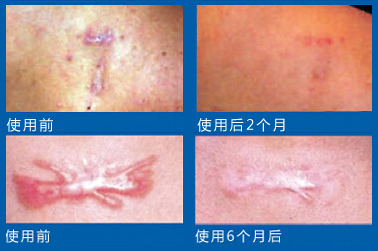 祛疤药怎么辨别真假,怎样挑选祛疤膏