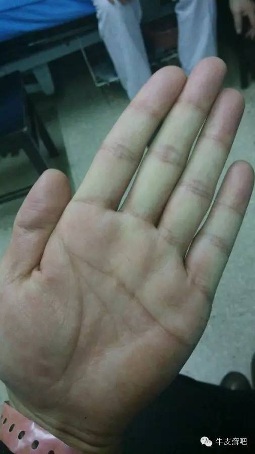 医院专家教你治疗牛皮癣,专家专治牛皮癣方法