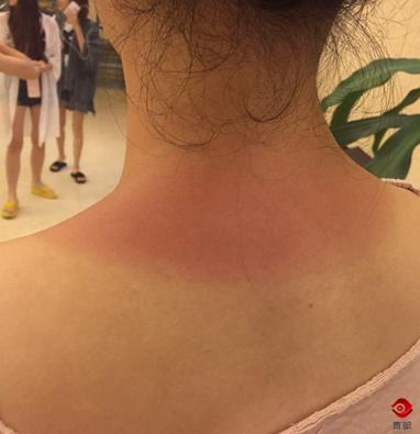 夏日军训旅行防晒,军训脸晒伤了怎么快速恢复