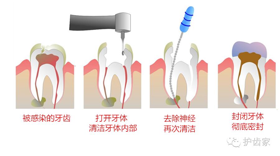 牙疼引起的牙疼怎么缓解,牙痛怎么办教你一招解决牙疼