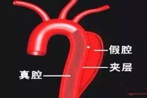 西京医院治疗心脏主动脉夹层,交大一附院治疗主动脉夹层