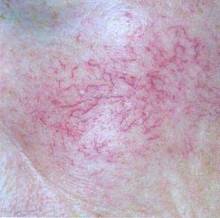 皮肤呈现红血丝怎么回事,皮肤红血丝是怎么引起的