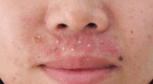 白头粉刺和白头闭口有什么区别,白头丘疹和白头粉刺区别