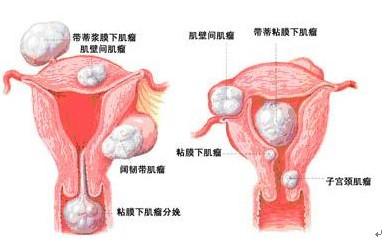 女性在什么情况下要切除子宫,女人在什么情况下要切子宫