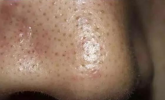 毛孔堵塞是不出汗的原因吗,毛孔阻塞是因为湿气太重了吗