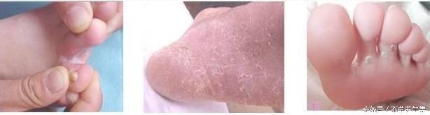 脚脱皮长水泡是哪种真菌感染,趾间糜烂型脚气穿过的鞋怎么处理