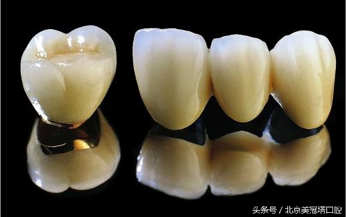 镶的烤瓷牙有什么不习惯的吗,为什么一定要镶烤瓷牙