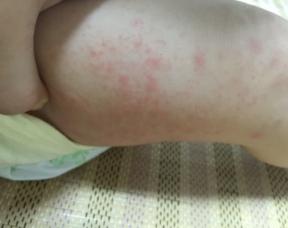 婴儿皮肤湿疹如何治疗,儿童湿疹溃烂怎么办