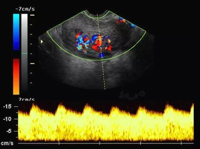 做b超要憋尿是早晨不尿吗,做b超为啥非得憋尿