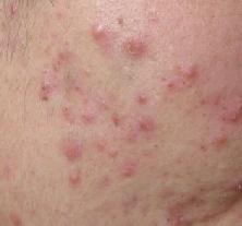 女性脸上痘痘怎么调理好得快,一个地方反复长痘如何处理