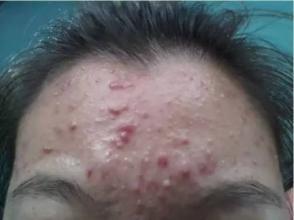 女性脸上痘痘怎么调理好得快,一个地方反复长痘如何处理