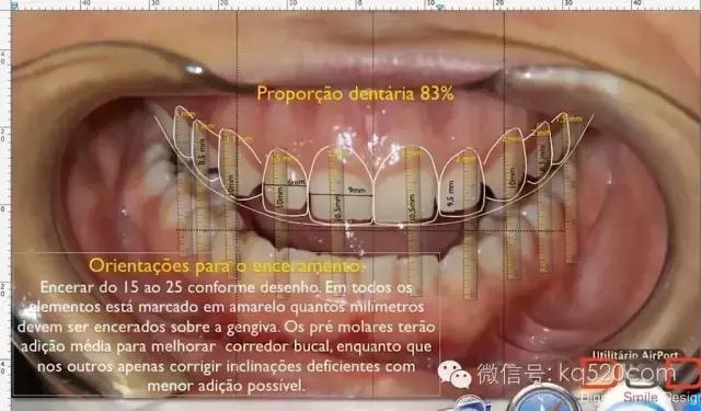 烤瓷牙变黑有必要更换吗,烤瓷牙边缘变黑怎么办