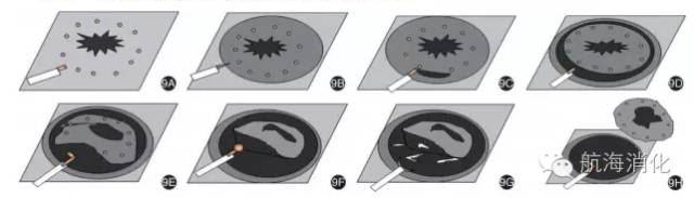 食管高级别上皮内瘤变选择治疗流程